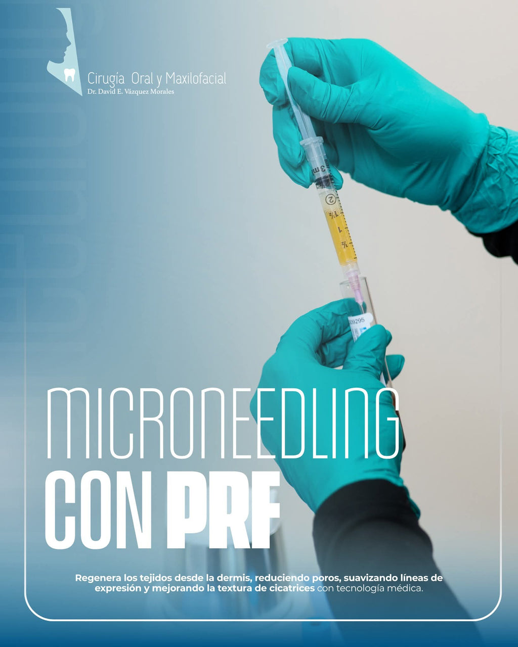 Microneedling with PRF (Platelet Rich Fibrin)