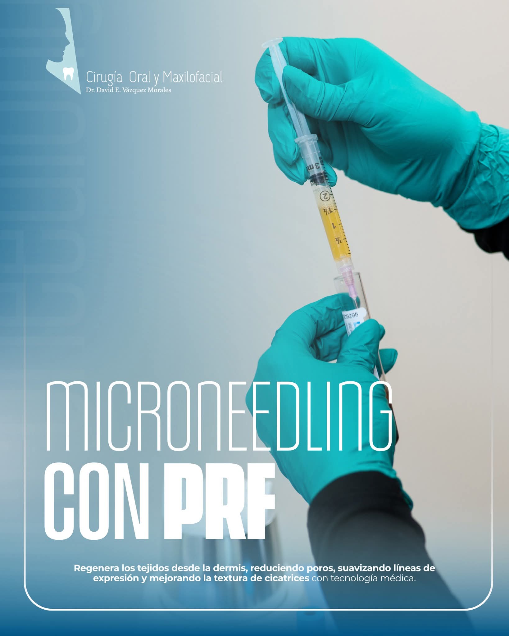 Microneedling with PRF (Platelet Rich Fibrin)